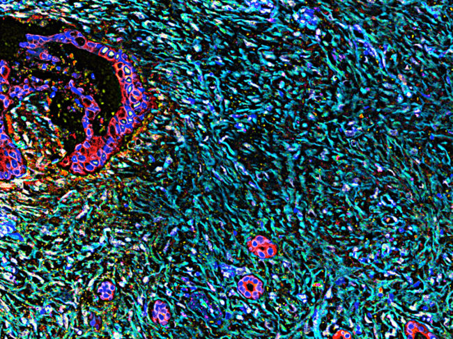 Pancreatic desmoplasia