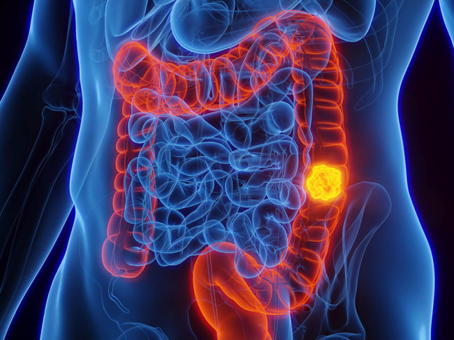 Colorectal cancer 3D illustration