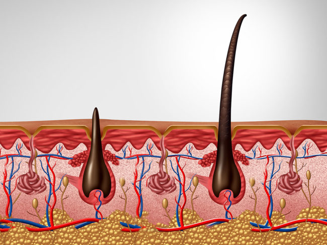 Medical illustration showing cross section of skin with hair follicles