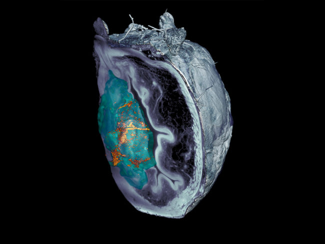 Accumulation of nanorobots in a bladder tumor by microscopy.