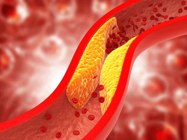 Cholesterol plaque in artery