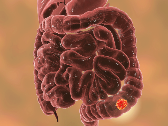 Colorectal cancer illustration