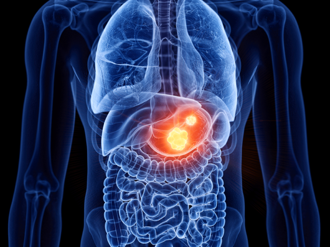 Gastric cancer