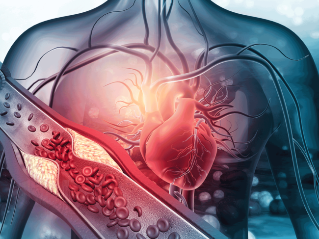 Heart with blocked arteries