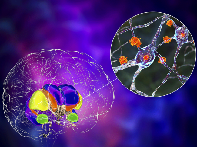 Dorsal striatum and its neurons in Huntington's disease