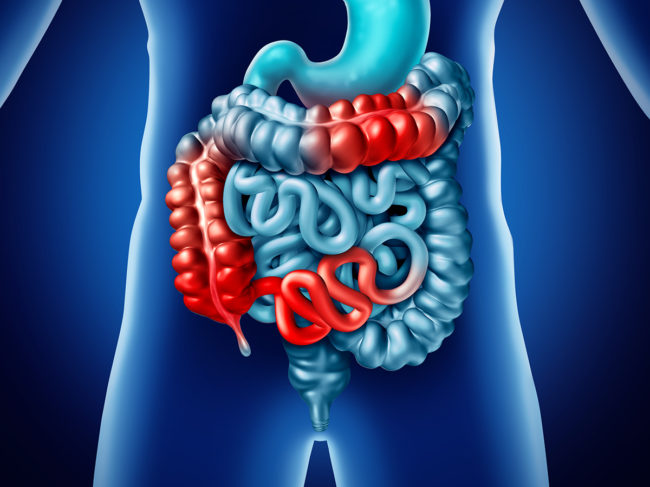 Illustration of intestines with inflammation