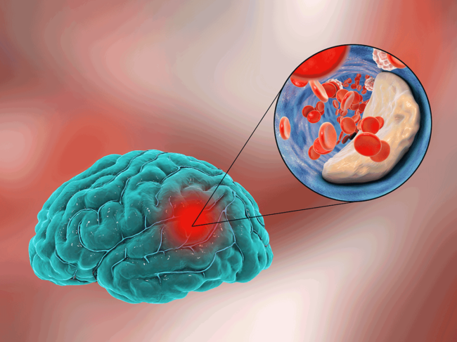 Ischemic stroke