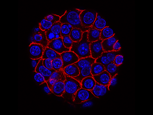 Pancreatic cancer cells.