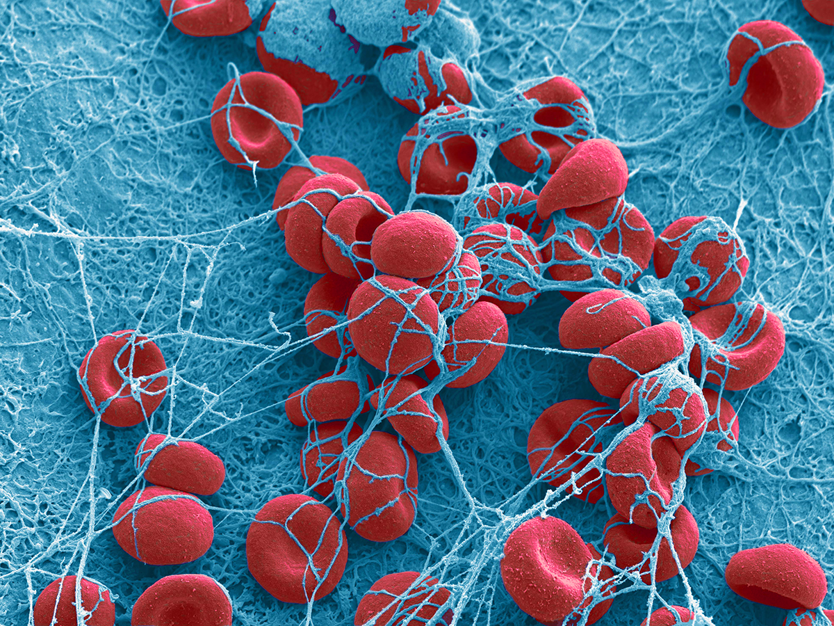 Blood clot under microscope.