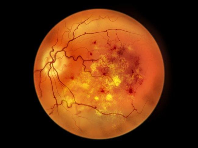 Illustration of ophthalmoscopic view of diabetic retinopathy.